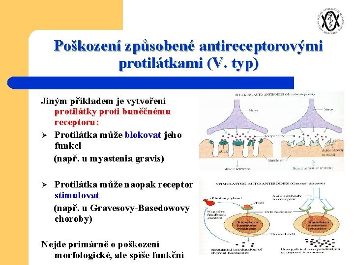 Poškození způsobené antireceptorovými protilátkami (V. typ) Jiným příkladem je vytvoření protilátky proti buněčnému receptoru: