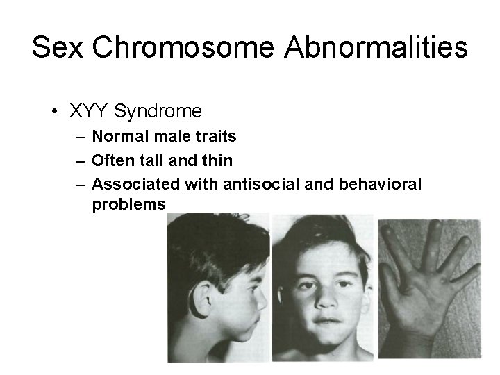 Sex Chromosome Abnormalities • XYY Syndrome – Normal male traits – Often tall and