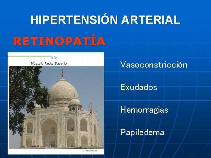 HIPERTENSIÓN ARTERIAL RETINOPATÍA Vasoconstricción Exudados Hemorragias Papiledema 