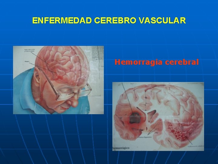 ENFERMEDAD CEREBRO VASCULAR Hemorragia cerebral 