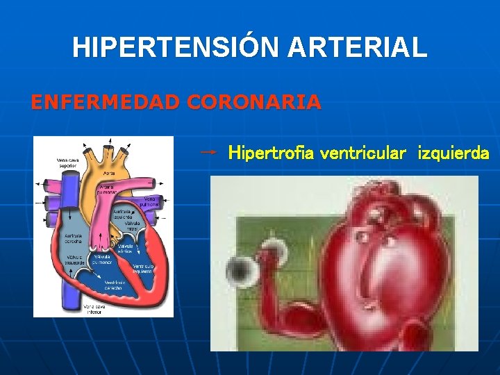HIPERTENSIÓN ARTERIAL ENFERMEDAD CORONARIA → Hipertrofia ventricular izquierda 