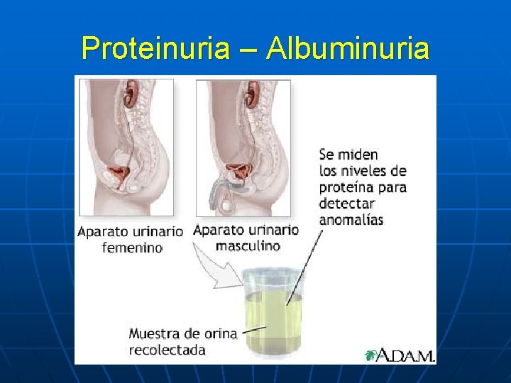 Proteinuria – Albuminuria 