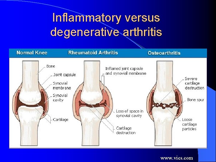 Inflammatory versus degenerative arthritis www. vics. com Inflammatory versus degenerative arthritis www. vics. com