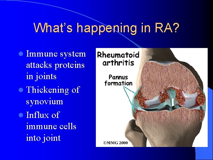 What’s happening in RA? l Immune system attacks proteins in joints l Thickening of What’s happening in RA? l Immune system attacks proteins in joints l Thickening of