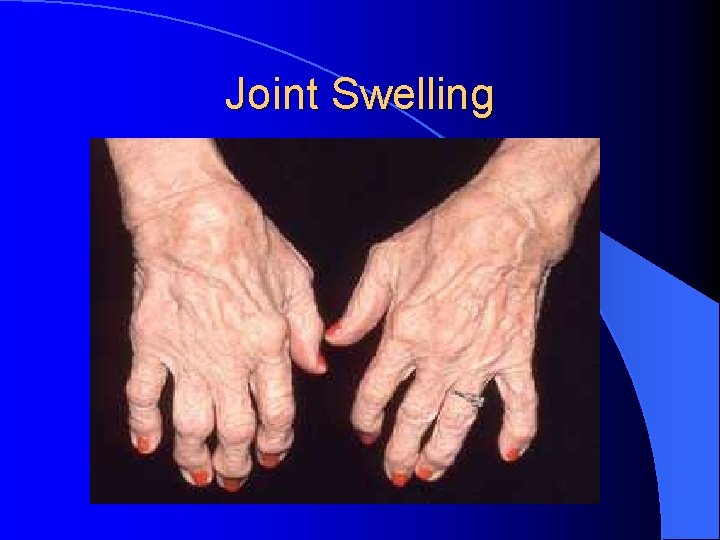 Joint Swelling Joint Swelling