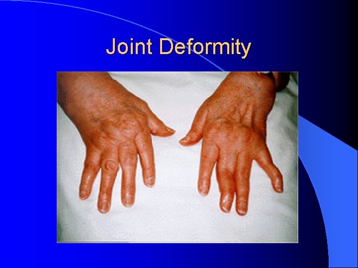 Joint Deformity Joint Deformity