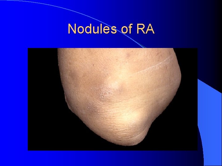 Nodules of RA Nodules of RA