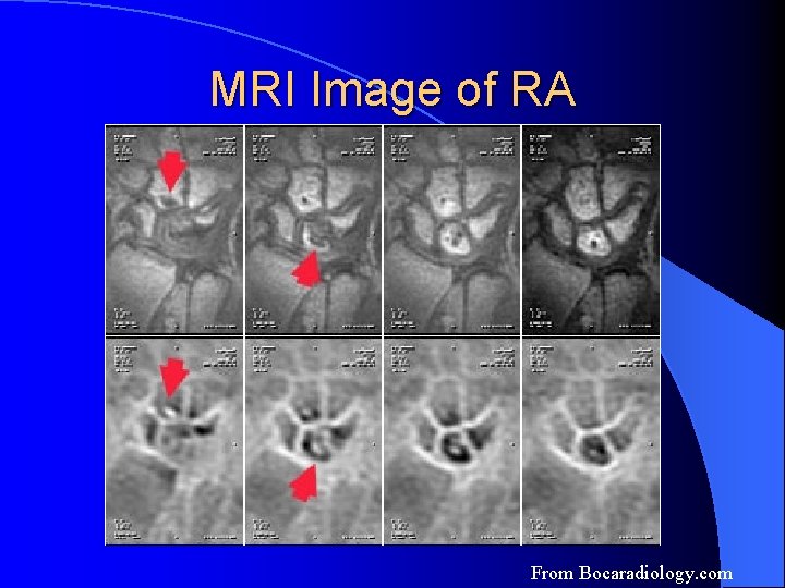 MRI Image of RA From Bocaradiology. com MRI Image of RA From Bocaradiology. com