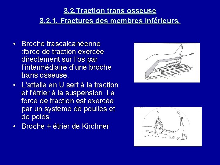 3. 2. Traction trans osseuse 3. 2. 1. Fractures des membres inférieurs. • Broche