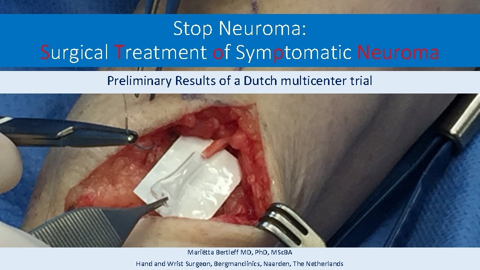 Stop Neuroma: Surgical Treatment of Symptomatic Neuroma Preliminary Results of a Dutch multicenter trial