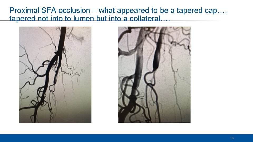 Proximal SFA occlusion – what appeared to be a tapered cap…. tapered not into