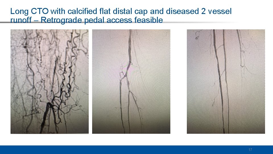 Long CTO with calcified flat distal cap and diseased 2 vessel runoff – Retrograde