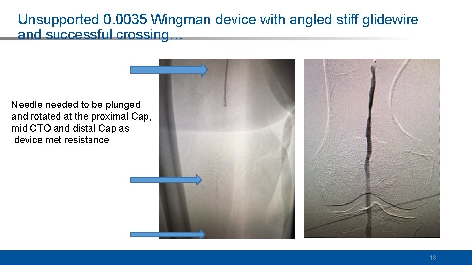 Unsupported 0. 0035 Wingman device with angled stiff glidewire and successful crossing… Needle needed
