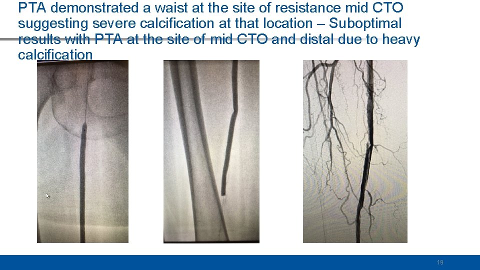 PTA demonstrated a waist at the site of resistance mid CTO suggesting severe calcification