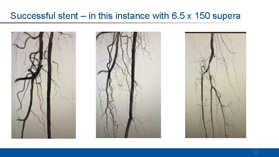 Successful stent – in this instance with 6. 5 x 150 supera 20 