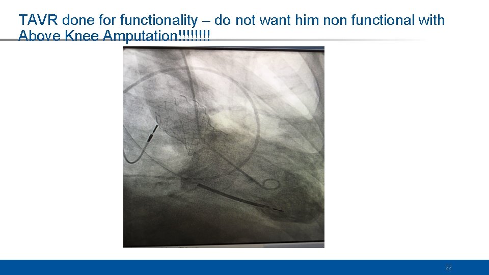 TAVR done for functionality – do not want him non functional with Above Knee