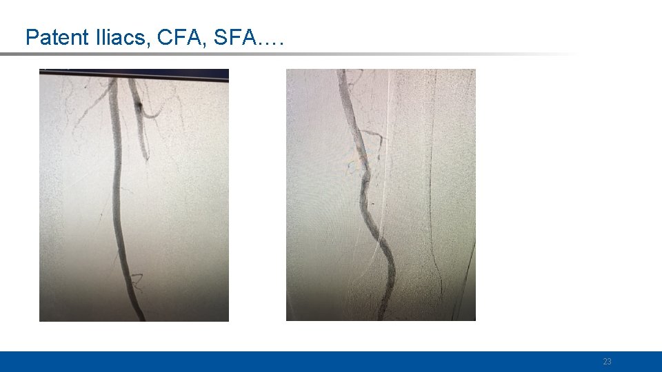 Patent Iliacs, CFA, SFA…. 23 