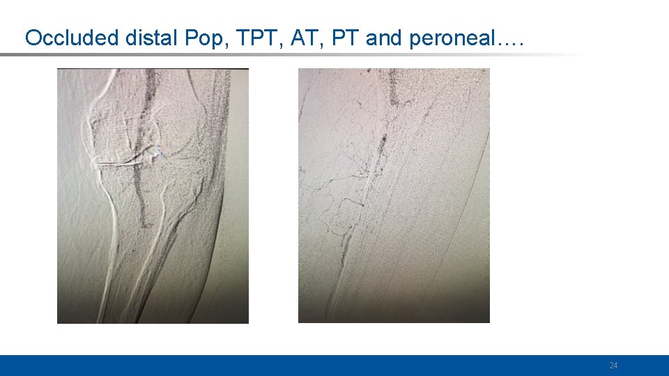 Occluded distal Pop, TPT, AT, PT and peroneal…. 24 