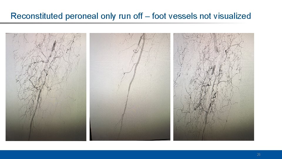 Reconstituted peroneal only run off – foot vessels not visualized 26 