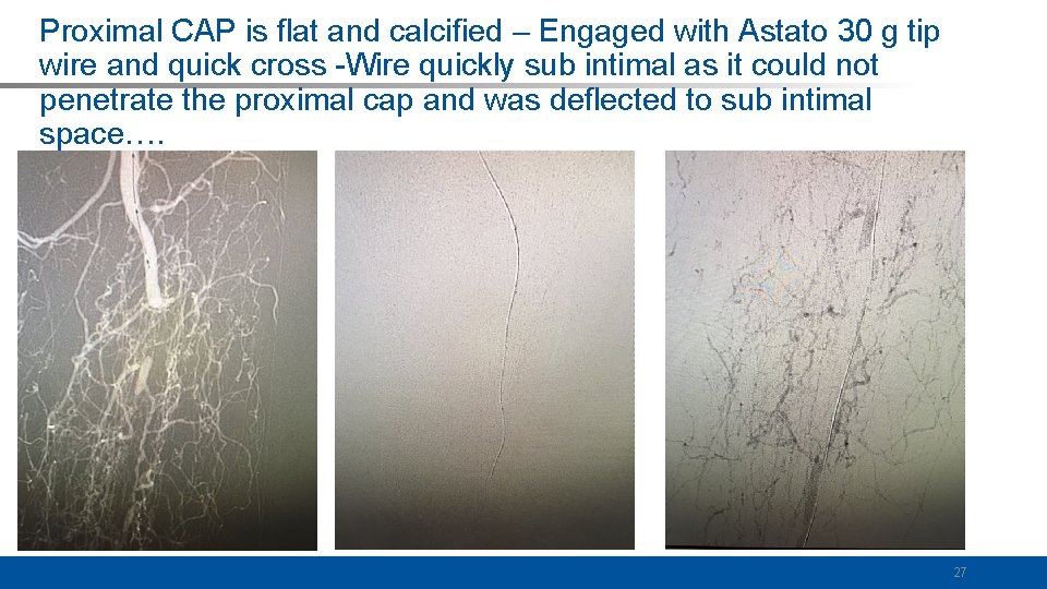 Proximal CAP is flat and calcified – Engaged with Astato 30 g tip wire