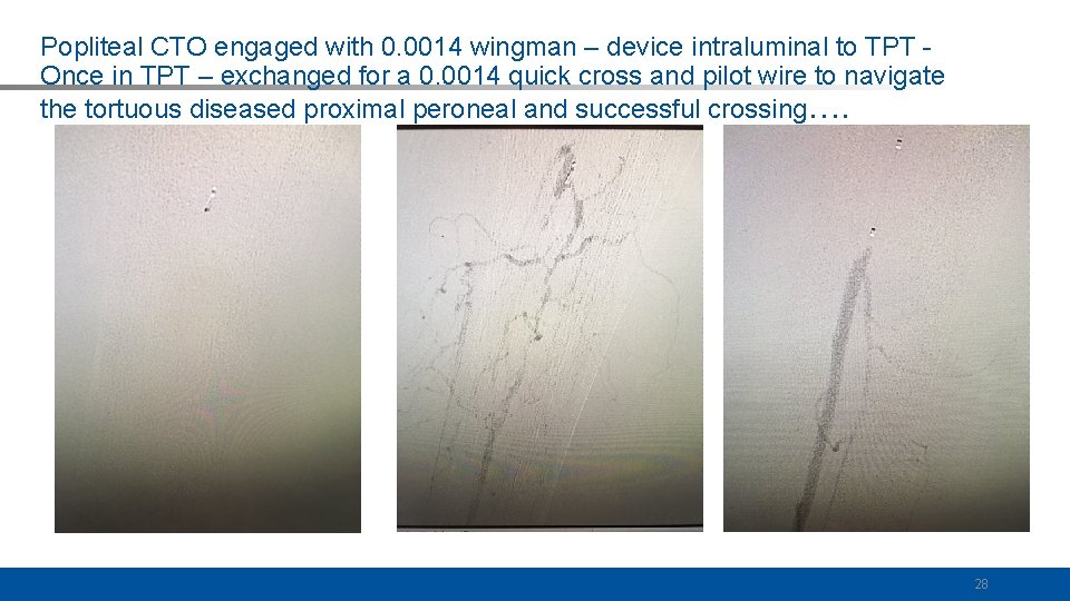 Popliteal CTO engaged with 0. 0014 wingman – device intraluminal to TPT Once in