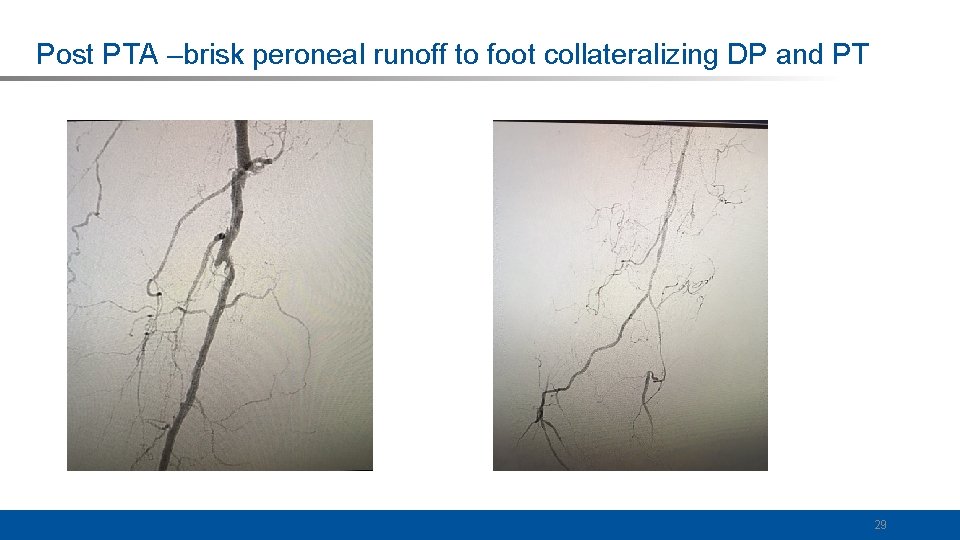 Post PTA –brisk peroneal runoff to foot collateralizing DP and PT 29 