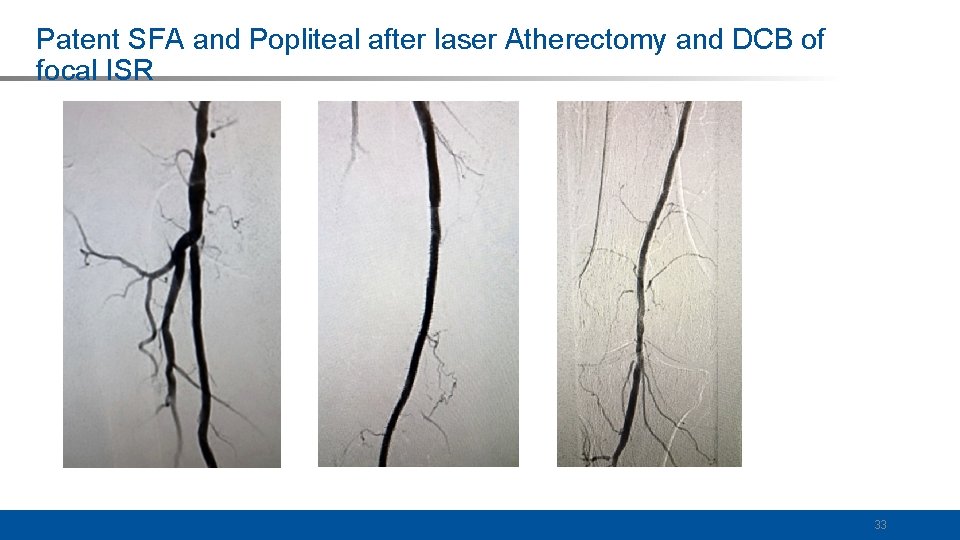 Patent SFA and Popliteal after laser Atherectomy and DCB of focal ISR 33 