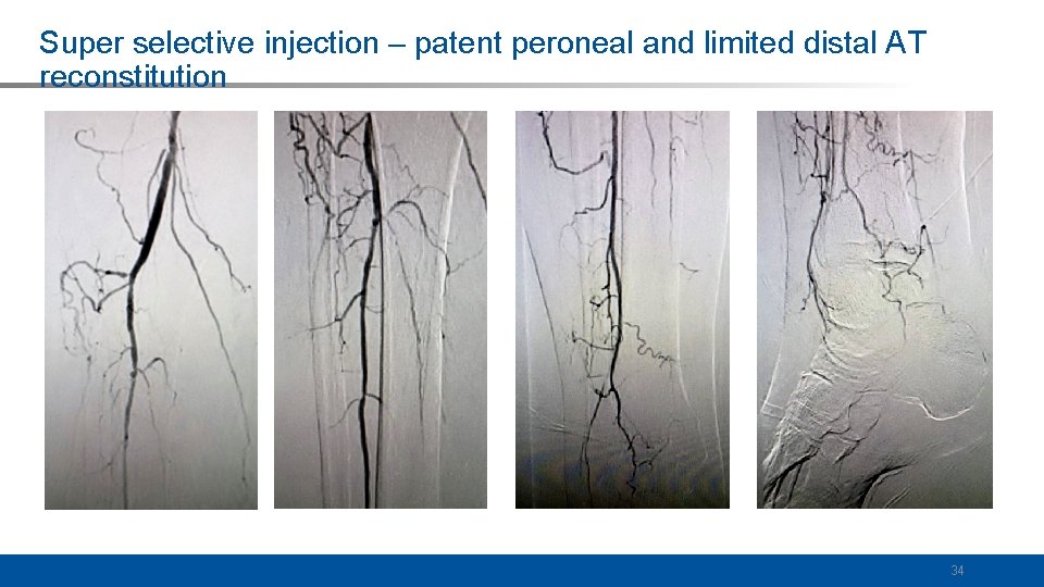 Super selective injection – patent peroneal and limited distal AT reconstitution 34 