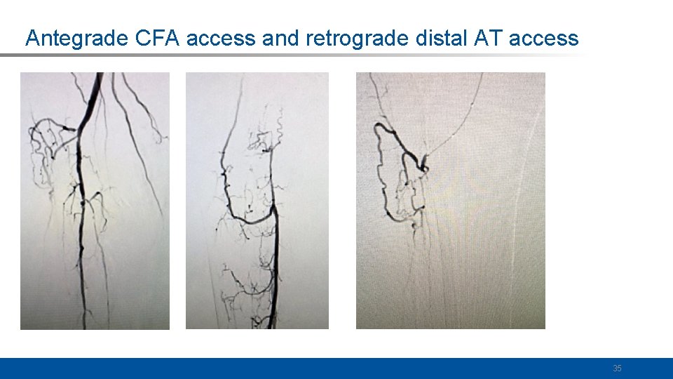 Antegrade CFA access and retrograde distal AT access 35 