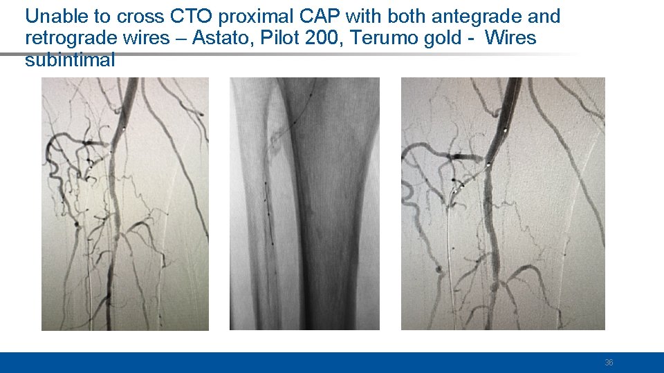 Unable to cross CTO proximal CAP with both antegrade and retrograde wires – Astato,