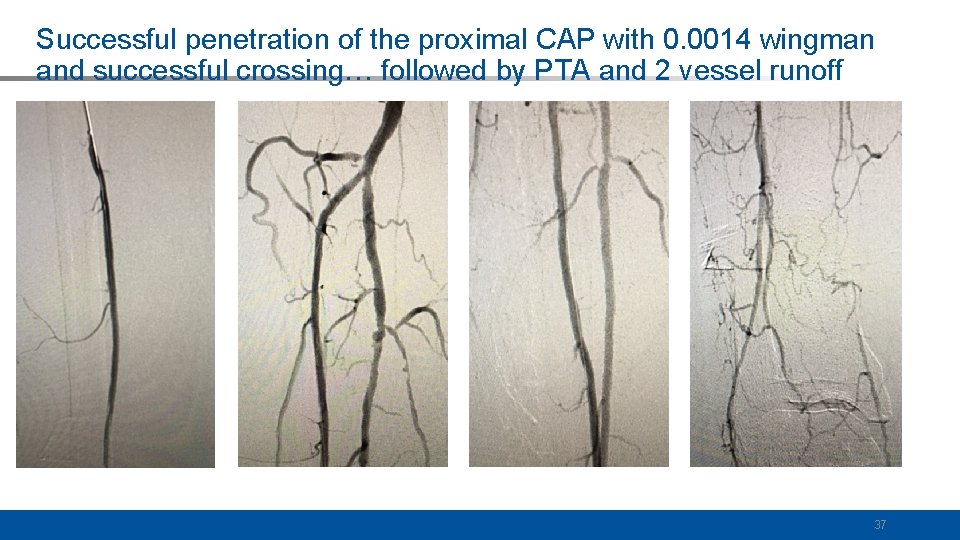 Successful penetration of the proximal CAP with 0. 0014 wingman and successful crossing… followed