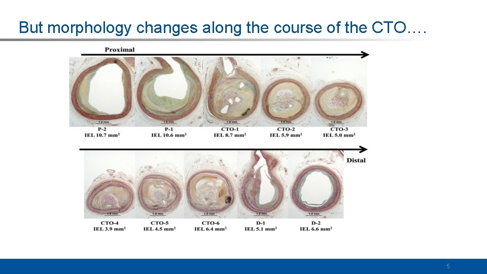 But morphology changes along the course of the CTO…. 5 