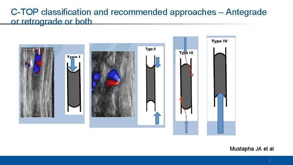 C-TOP classification and recommended approaches – Antegrade or retrograde or both Mustapha JA et