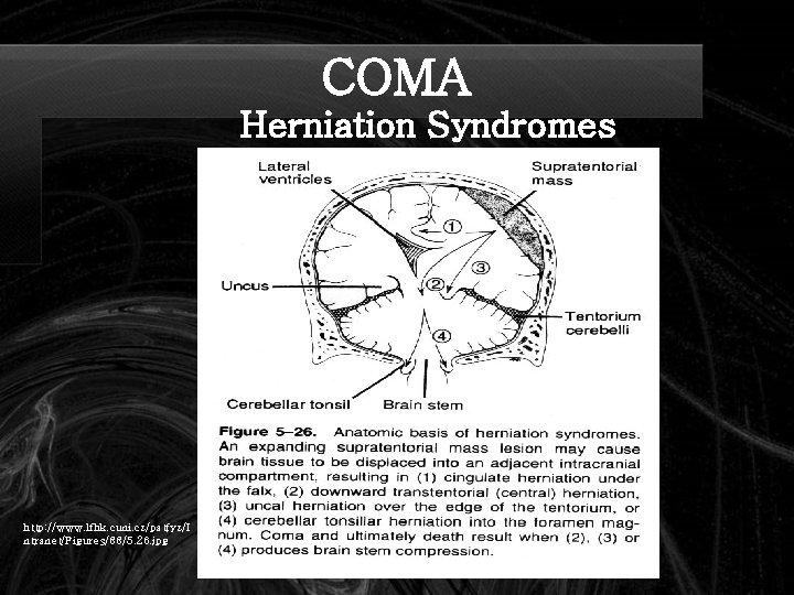 COMA Herniation Syndromes http: //www. lfhk. cuni. cz/patfyz/I ntranet/Figures/88/5. 26. jpg 