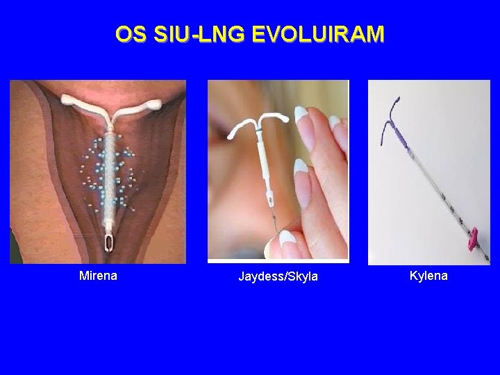 OS SIU-LNG EVOLUIRAM Mirena Jaydess/Skyla Kylena 
