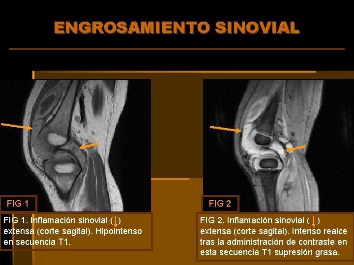 ENGROSAMIENTO SINOVIAL FIG 1. Inflamación sinovial ( ) extensa (corte sagital). Hipointenso en secuencia