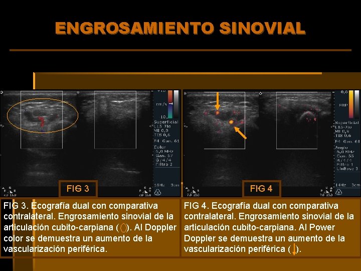 ENGROSAMIENTO SINOVIAL FIG 3. Ecografía dual con comparativa contralateral. Engrosamiento sinovial de la articulación