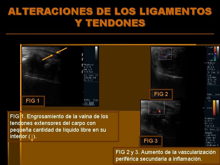 ALTERACIONES DE LOS LIGAMENTOS Y TENDONES FIG 2 FIG 1. Engrosamiento de la vaina