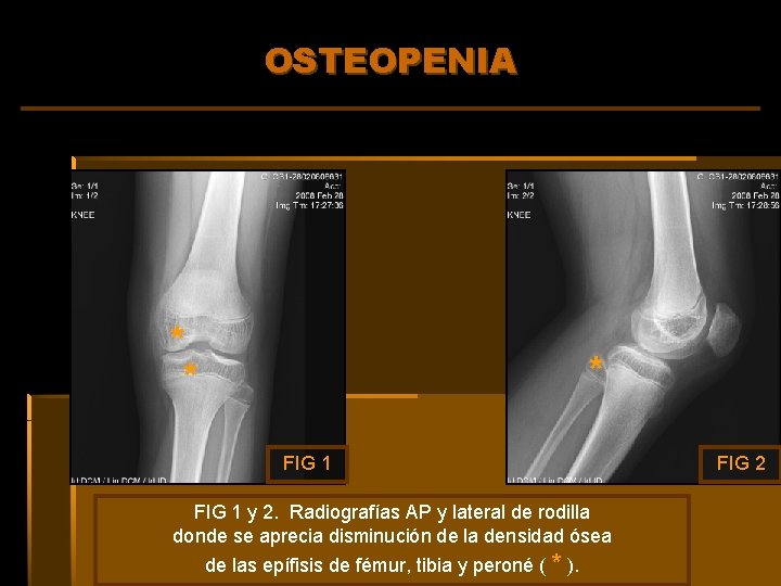OSTEOPENIA * * * FIG 1 y 2. Radiografías AP y lateral de rodilla