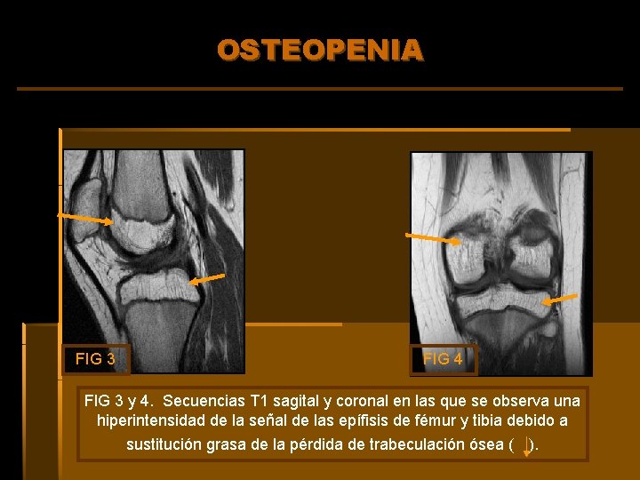 OSTEOPENIA FIG 3 FIG 4 FIG 3 y 4. Secuencias T 1 sagital y