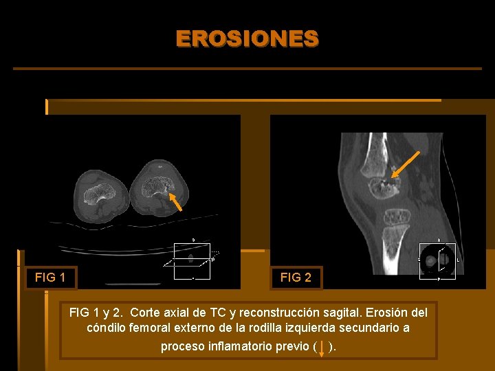 EROSIONES FIG 1 FIG 2 FIG 1 y 2. Corte axial de TC y