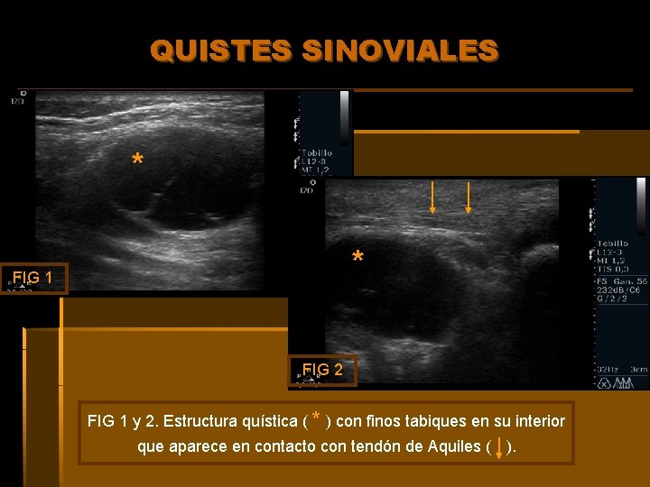 QUISTES SINOVIALES * * FIG 1 FIG 2 FIG 1 y 2. Estructura quística