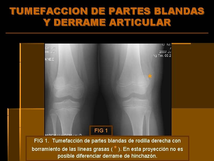 TUMEFACCION DE PARTES BLANDAS Y DERRAME ARTICULAR * FIG 1. Tumefacción de partes blandas