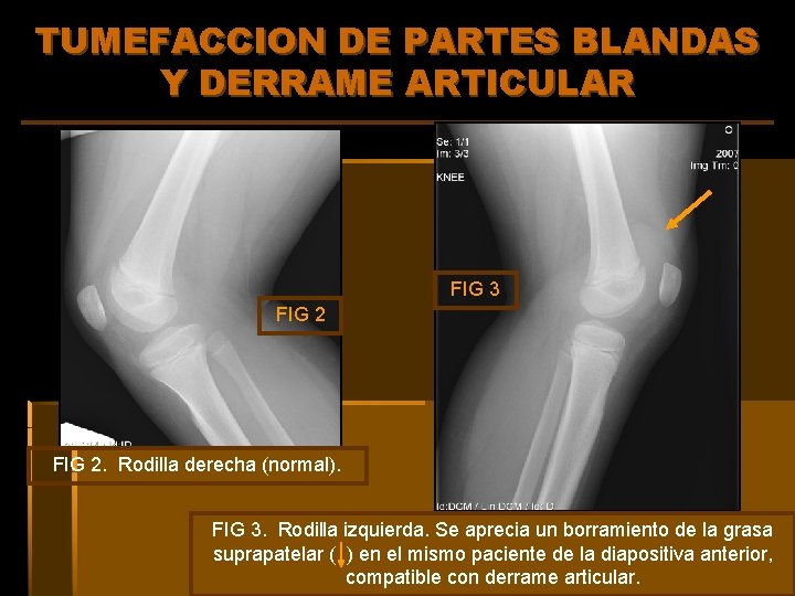 TUMEFACCION DE PARTES BLANDAS Y DERRAME ARTICULAR FIG 3 FIG 2. Rodilla derecha (normal).