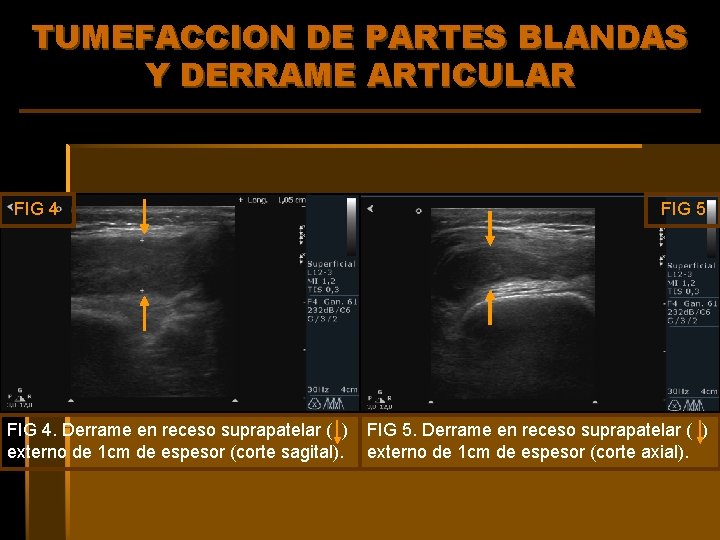 TUMEFACCION DE PARTES BLANDAS Y DERRAME ARTICULAR FIG 4. Derrame en receso suprapatelar (