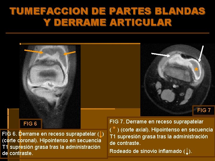 TUMEFACCION DE PARTES BLANDAS Y DERRAME ARTICULAR * FIG 7 FIG 6. Derrame en