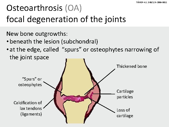 Osteoarthrosis (OA) focal degeneration of the joints TÁMOP-4. 1. 2 -08/1/A-2009 -0011 New bone