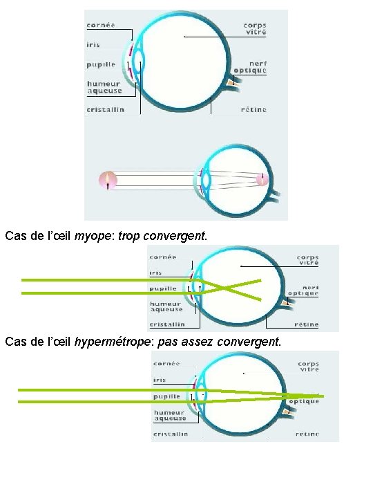 Cas de l’œil myope: trop convergent. Cas de l’œil hypermétrope: pas assez convergent. 