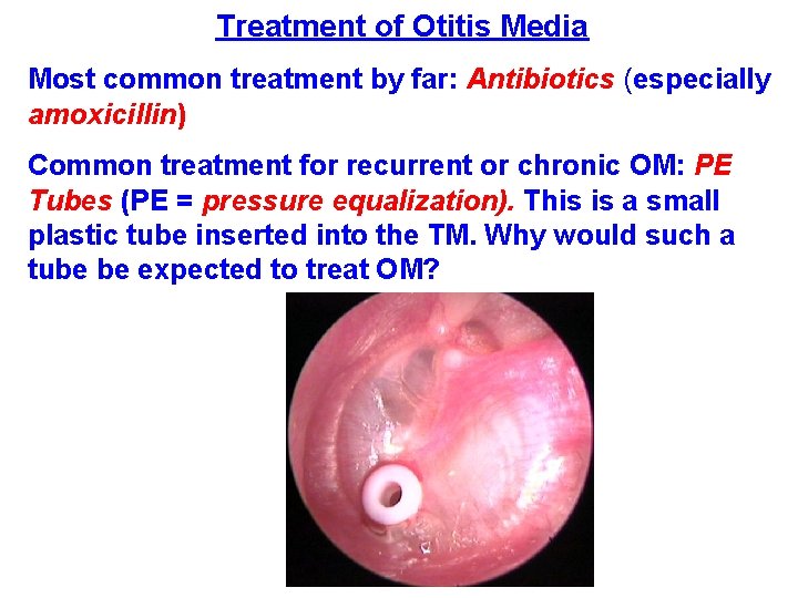Treatment of Otitis Media Most common treatment by far: Antibiotics (especially amoxicillin) Common treatment Treatment of Otitis Media Most common treatment by far: Antibiotics (especially amoxicillin) Common treatment