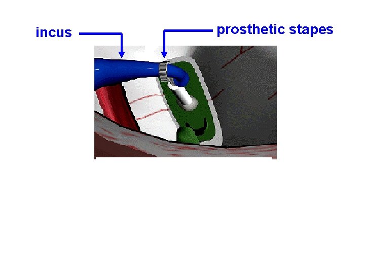 incus prosthetic stapes 